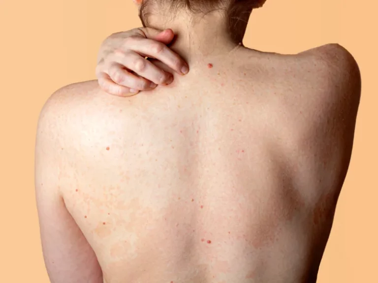 body acne in a woman